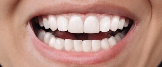 jovem-mulher-sorridente-antes-e-depois-da-instalacao-de-facetas-correcao-de-dentes-irregulares-com_407348-27482